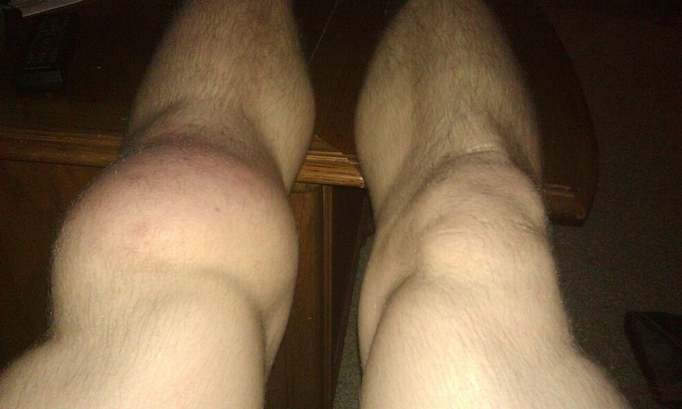 Knee na léčbu OstyHealth