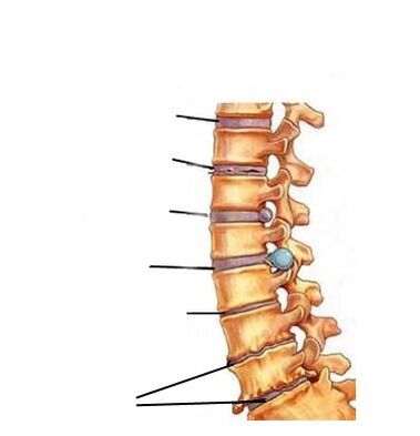 Fáze vývoje osteochondrosy