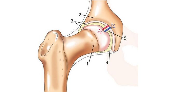 kyčelního kloubu a artrózy