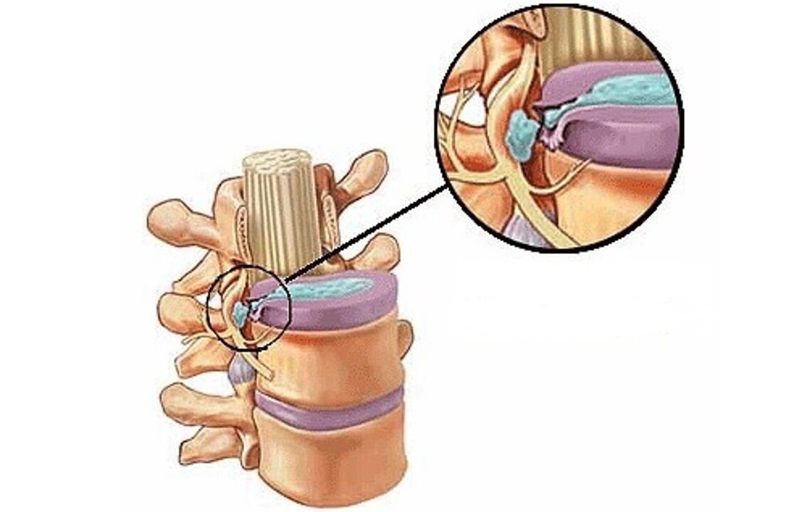 intervertebrální kýla s hrudní osteochondrózou
